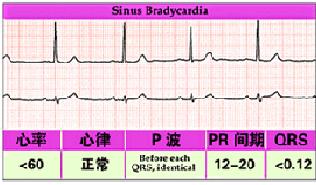 竇性心動過緩